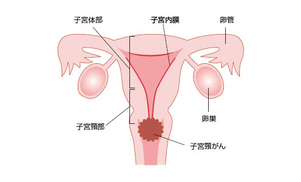 子宮頸がんの症状
