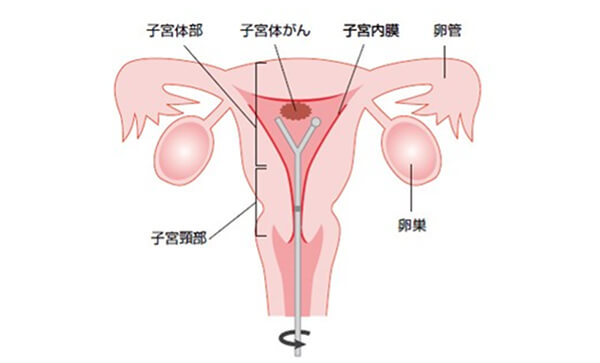 子宮体がんの症状