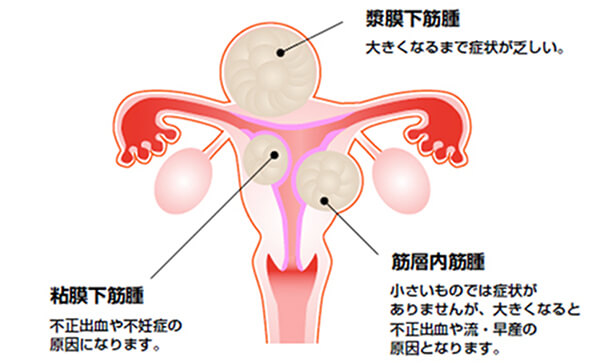 子宮筋腫の説明