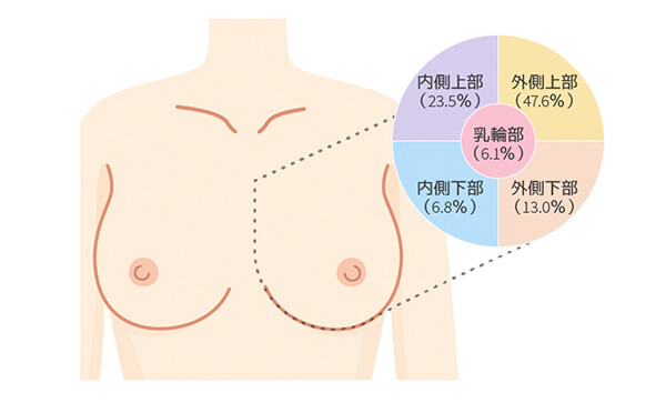 乳がんの部位別発生頻度