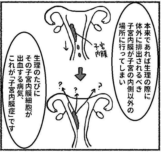 子宮内膜症日記9