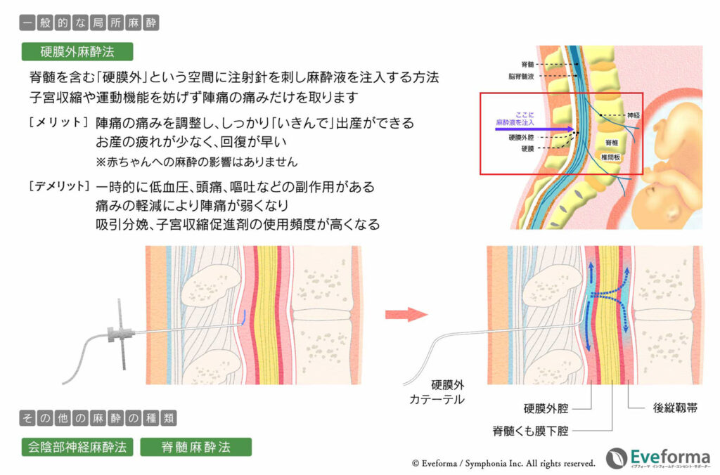 「硬膜外麻酔法の説明図。背骨の硬膜外腔にカテーテルで麻酔を注入し、陣痛の痛みを和らげる仕組みとメリット・デメリットを示している。」