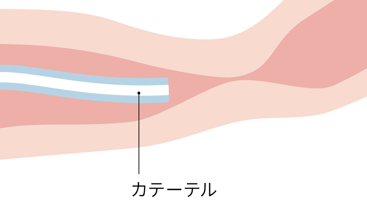 挿入・観察