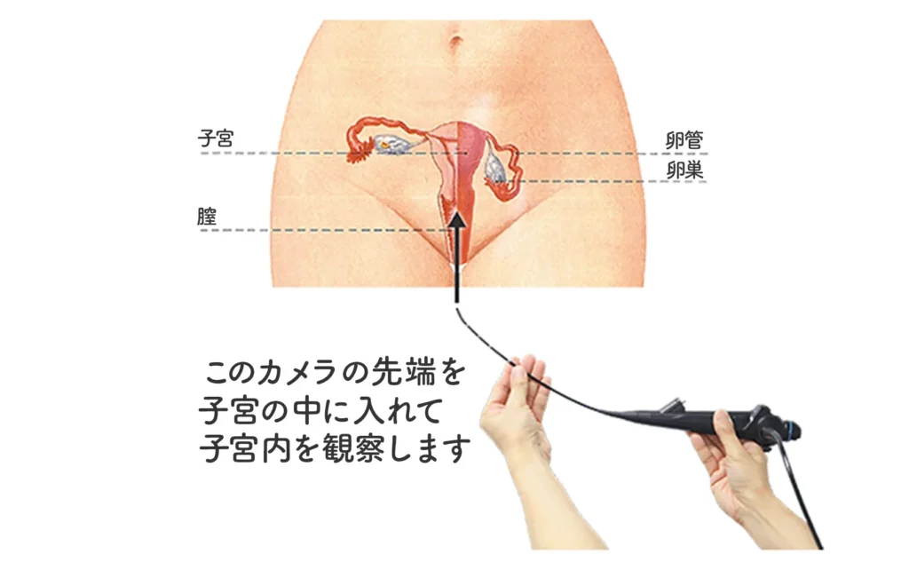 子宮鏡検査