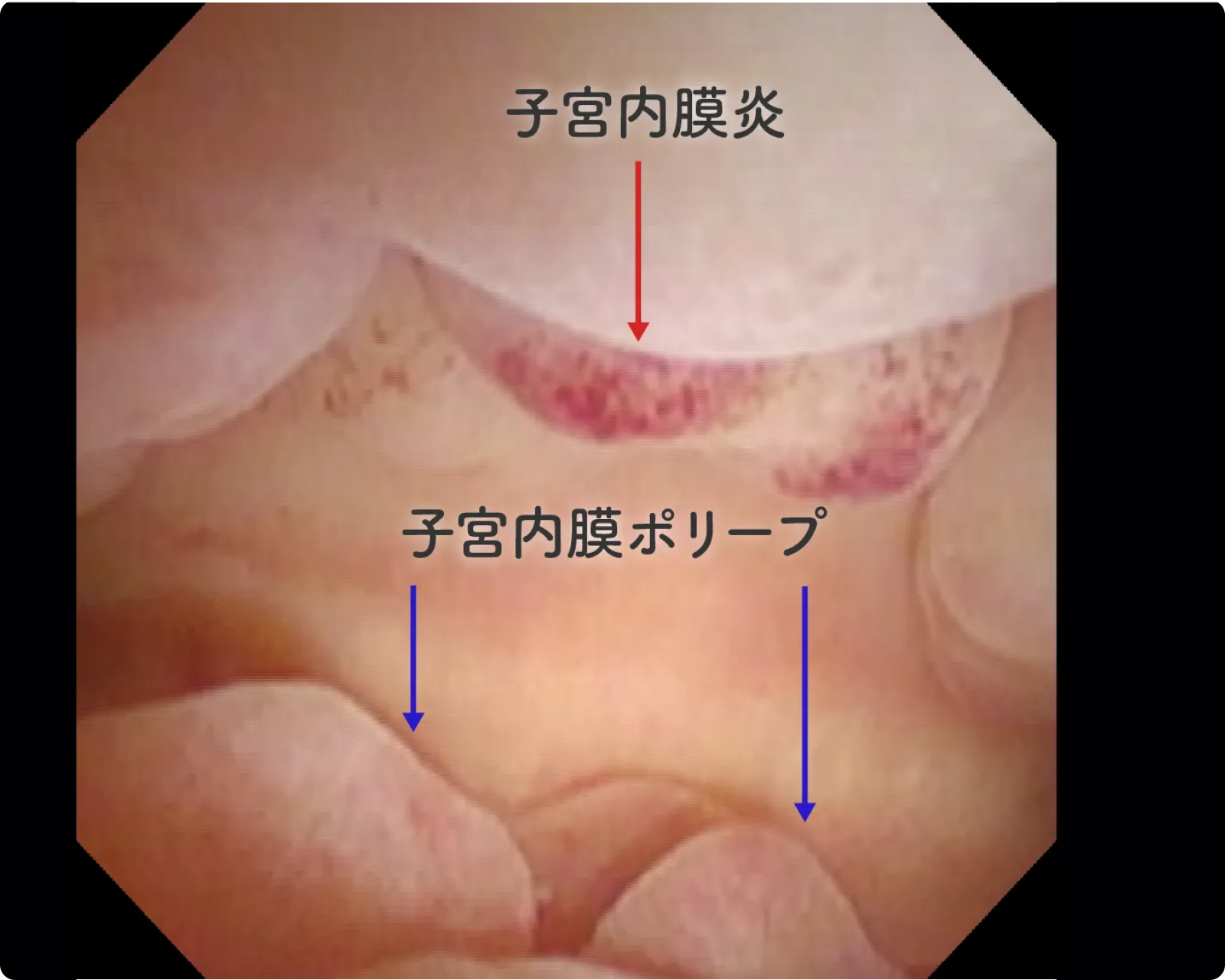 子宮内膜ポリープが存在している内腔