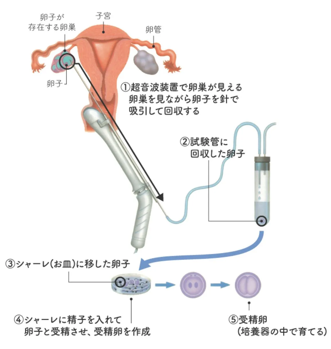 体外受精の手順