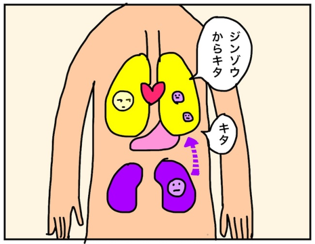 43歳で腎がんになった話 21